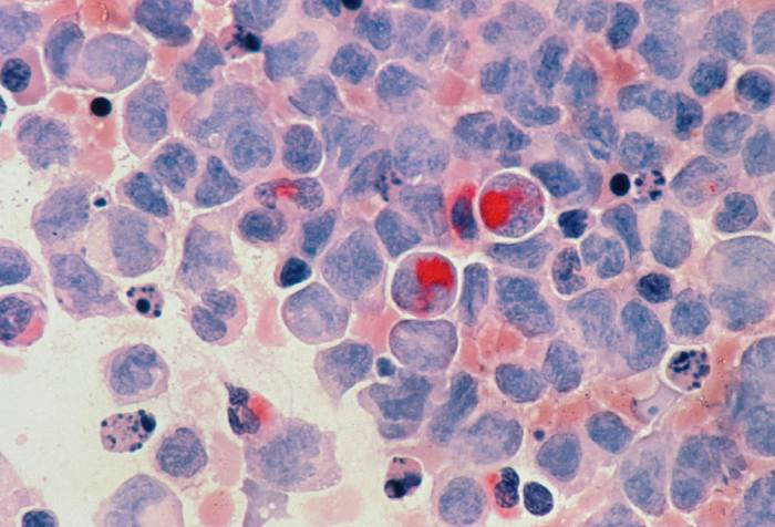 An microscopic image of cancer cells (acute myelocytic leukaemia, AML)